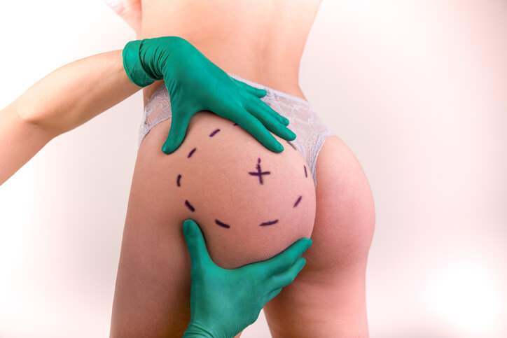 recuperacio gluteoplastia